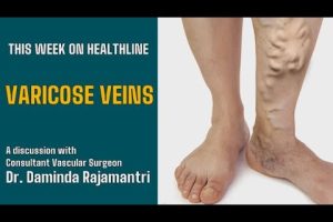 Varicose veins, symptom profile, diagnosis, and treatment. - Healthline - Episode - 39